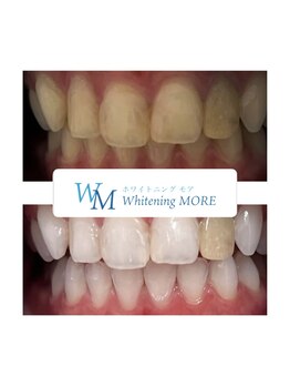 ホワイトニング モア(Whitening MORE)/ビフォーアフター