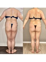 カルナ(CARNA)/【痩身】セルライトゼロ2