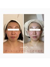 エデルビューティー(ederux beauty)/小顔コルギ