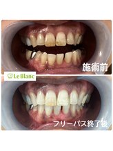 ルブラン 奈良店(Le Blanc)/頑固な着色汚れも綺麗に！