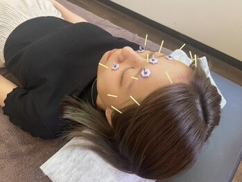 ふなと川接骨院 倉賀野院/眼精疲労の鍼施術【高崎　鍼灸】