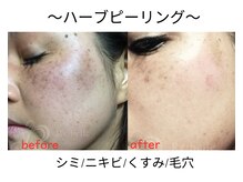 エール シガ(AILE SHIGA)/【ハーブピーリング】