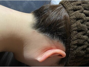 アムプラス(AM+)/えり足脱毛