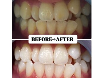 ホワイトニングサロン 豊中/Before&After美白ホワイトニング