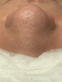 毛穴ケアをしたい