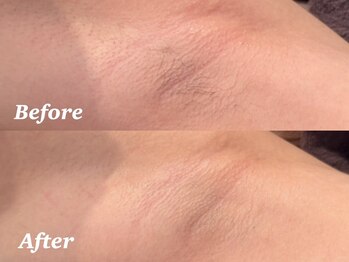 ディオーネ 西船橋駅前店(Dione)/美肌脇脱毛◇Before After