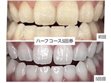ホワイトニングショップ 明石大久保店/【BeforeAfter】5回券のお客様