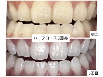 ホワイトニングショップ 明石大久保店/【BeforeAfter】5回券のお客様