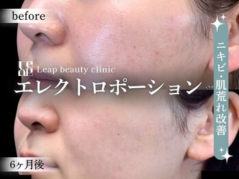 リープ(Leap)/エレクトロポレーション