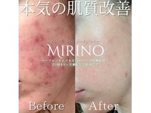ミリノ(Mirino)/業界最安値◎結果重視の肌質改善