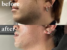 ボス 津店(BOSS)/【メンズ脱毛/ヒゲ脱毛】