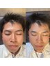 【1回で驚きの効果実感】理想の小顔に！小顔矯正×整顔☆特殊超音波器も併用