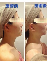 ルネ(Lune)/肩・首・デコルテもじっくりケア