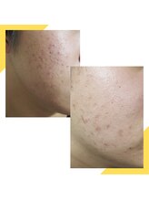 レヴェランジュ(Rebellange)/ニキビに働きかける施術