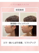 ミプラス鍼灸スタジオ/ビフォーアフター