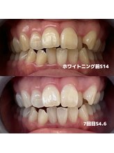 ホワイトニングビューティー 行橋店/ホワイトニング