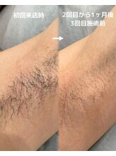 サロンドベルム(Salon de BELME)/ダブル脱毛：2回の施術効果