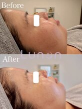 ルノン(Lunon)/毛穴洗浄ハイドロ×ララピール