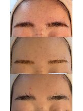 ムニ(muniii)/Before/After