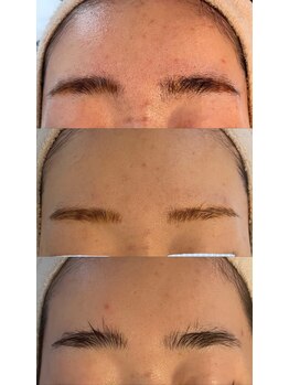 ムニ(muniii)/Before/After