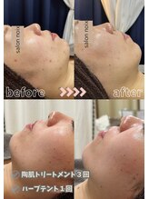 サロンノワ(salon noix)/《ハーブテントとの相乗効果》