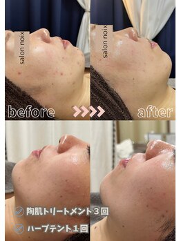 サロンノワ(salon noix)/《ハーブテントとの相乗効果》