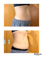 ヒーリングリゾート ナゴミ(Nagomi)/腹部の脂肪冷却＆電磁パルス