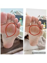 遊歩堂/ヒールダコ