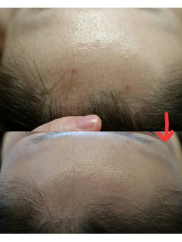 ベビースキン(baby skin)/ニキビ肌改善