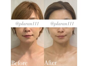 ボディヒーリングアンド小顔美容矯正 プララン/小顔矯正でお顔が一回り小さく☆