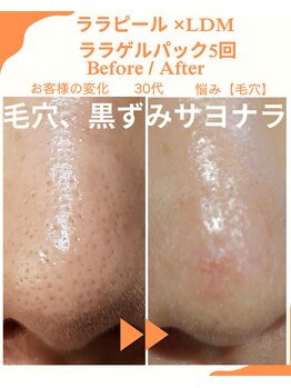 ルベル(Luvelle)/毛穴さよなら