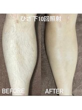 ココ(Coco)/メンズ脱毛　足