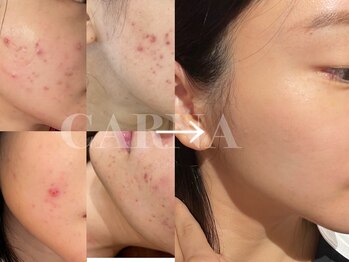 カルナ(CARNA)/繰り返す肌トラブル改善には