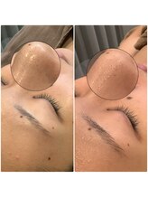 ブローチ 刈谷店(BROOCH)/毛穴ピーリングで毛穴ツルツル