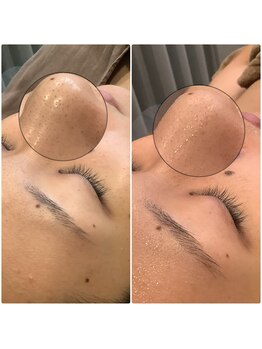 ブローチ 刈谷店(BROOCH)/毛穴ピーリングで毛穴ツルツル