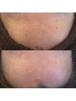 ハクビ(HAKUBI)/しわ、毛穴改善