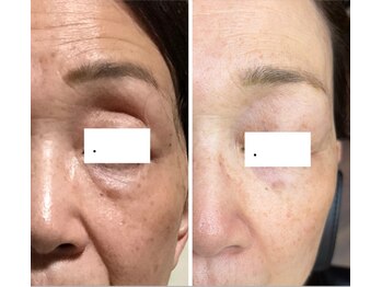 カムイ/ハーブピーリング2回