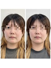 鍼灸ハリカラ/３０代前半のbefore/after