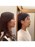 【残り3名】美容鍼+ララピーリング　通常16500円→初回9900円