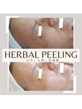 ラリマール/ハーブピーリング
