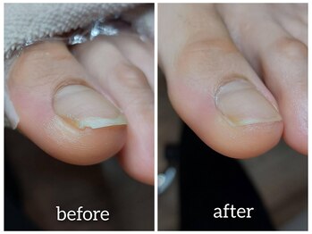 爪切り屋 足楽/【フットケア】欠ける自爪