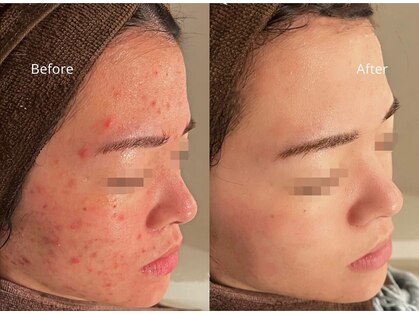 【毛穴|ハーブピーリング】韓国肌管理Belle 京都河原町【3/29 NEWOPEN(予定)】の写真