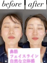 グローウィング整骨院 鍼灸院(Growing整骨院 鍼灸院)/EMS美容鍼