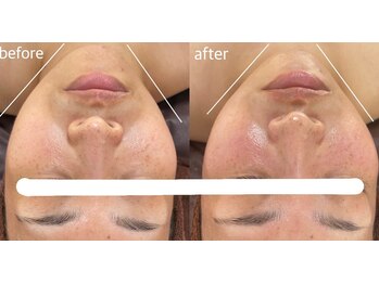 ライチャス(RAICHAS)/お顔脱毛+陶肌1回の効果