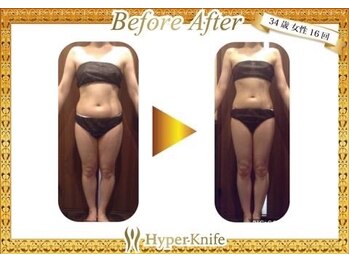 カワイ ビューティーサロン 新宿西口店(Kawai Beauty Salon)/【ハイパーナイフ】before/after