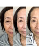 アーフ(ARF)/エクソリフト