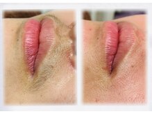 ブリリアンス(BRILLIANCE)/〇フェイスワックス脱毛〇