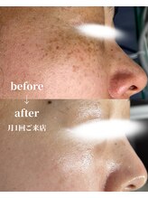 レイ(Rey)/シミ改善 月1回2メニュー