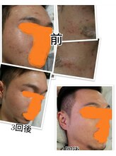 ベビースキン(baby skin)/肌改善