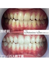 ホワイトニングサロン 京都烏丸店/ホワイトニング施術例　
